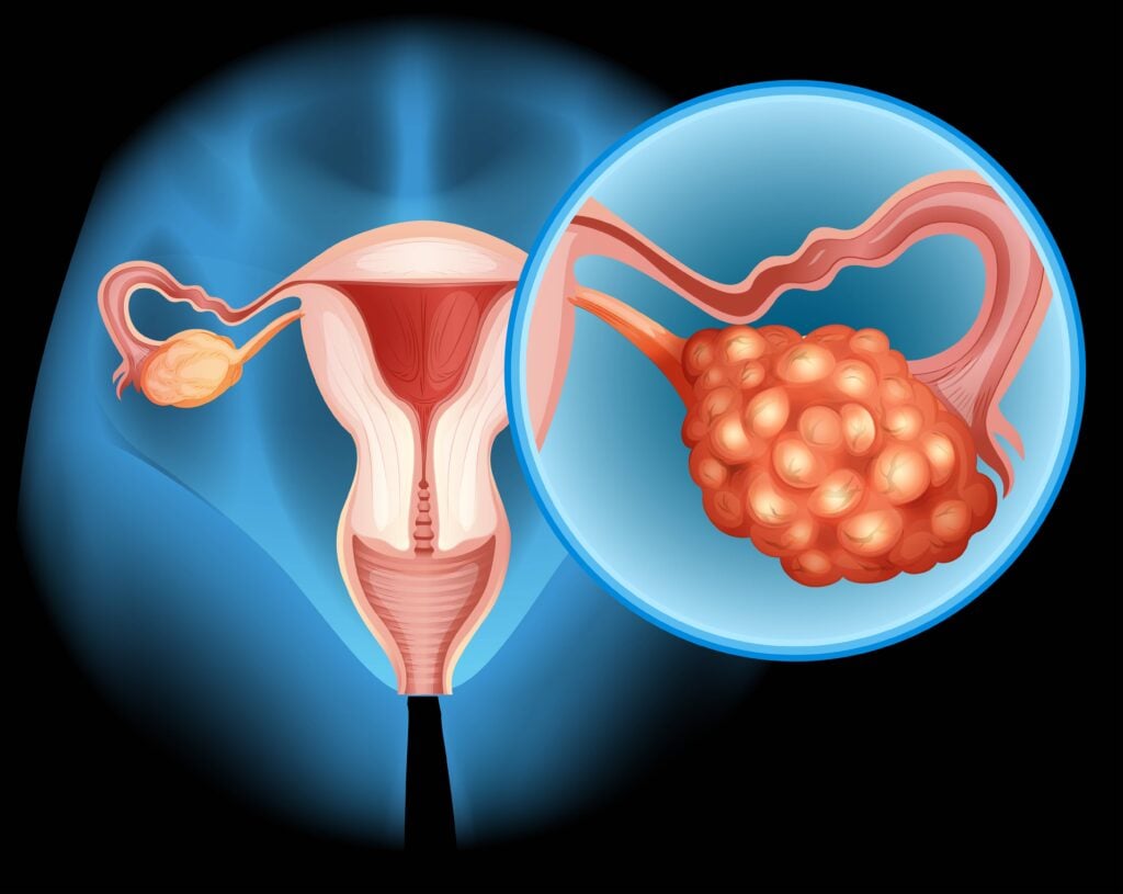 A photo explaining how to avoid Miscarriage with PCOS 
