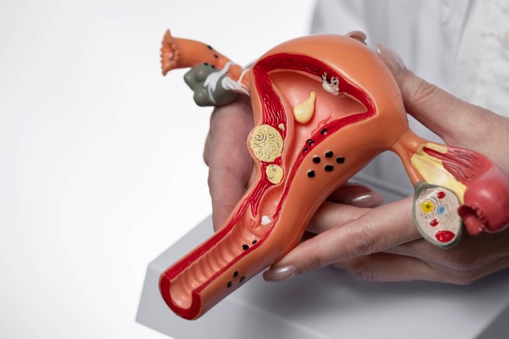 a plastic model showing the beginning of pregnancy in a vagina with PCOS