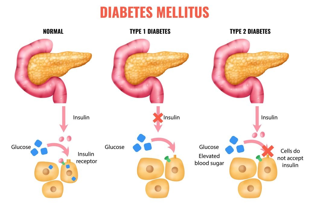 a picture explaining how to cure insulin resistance to prevent diabetes